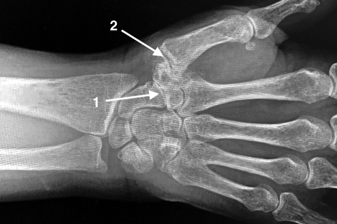 osteoarthritis-scaphotrapezial-trapezoid-stt-joint-hand-surgery-source